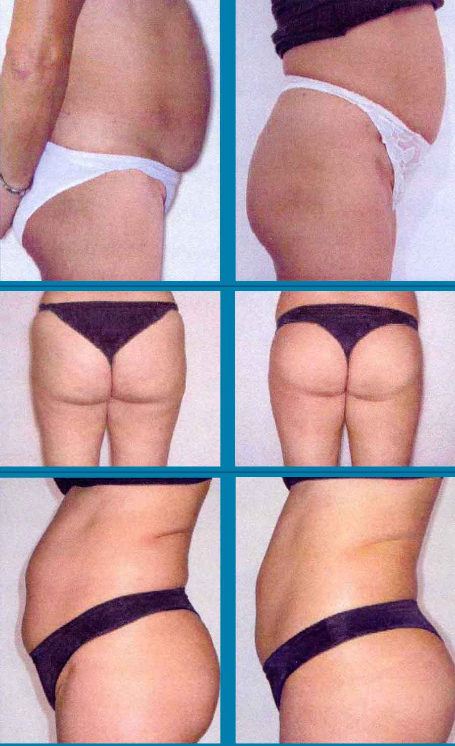 Therma Shape Before And After Pictures