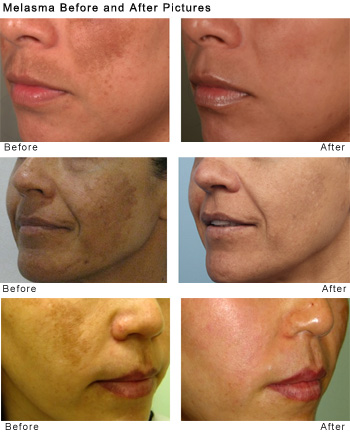 melasma before and after